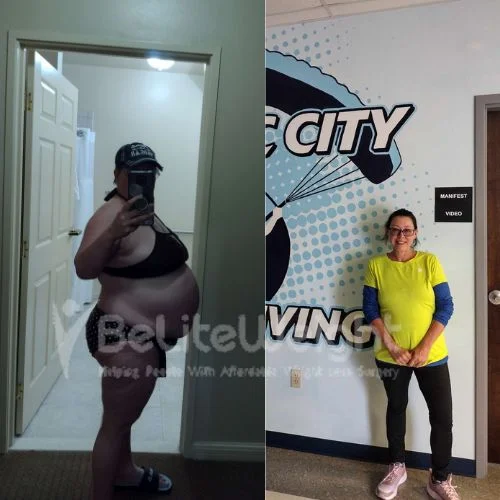 Misty C - gastric sleeve - 1 year update*